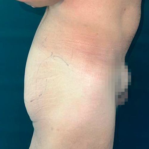 Implante de glúteos (Hombre)