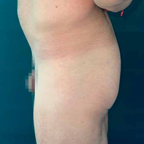 Implante de glúteos (Hombre)