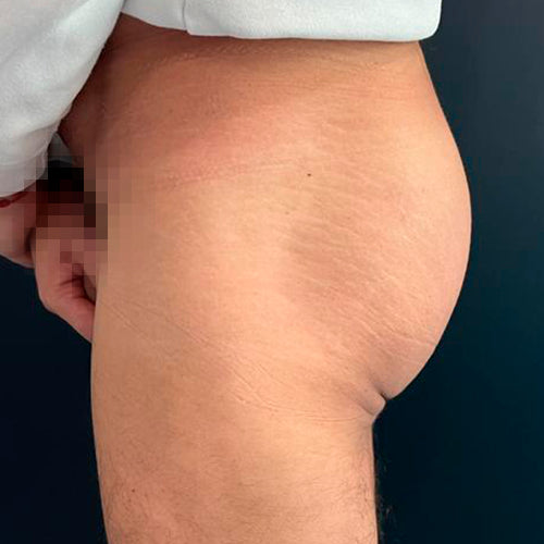 Implante de glúteos (Hombre)