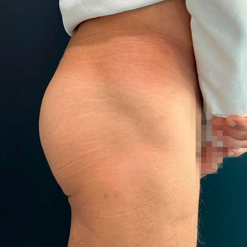 Implante de glúteos (Hombre)