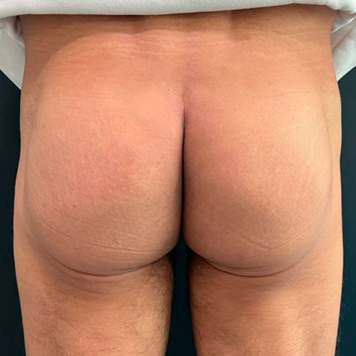 Implante de glúteos (Hombre)