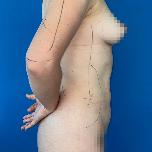 Lipoescultura localizada