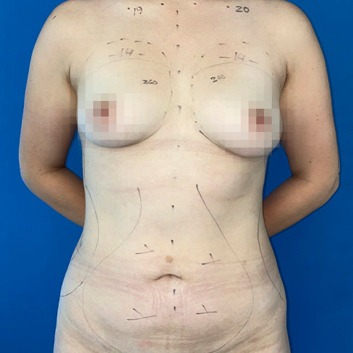 Lipoescultura localizada