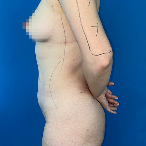 Lipoescultura localizada