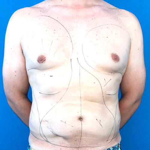 Lipoescultura localizada