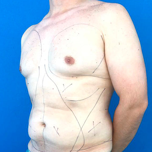 Lipoescultura localizada