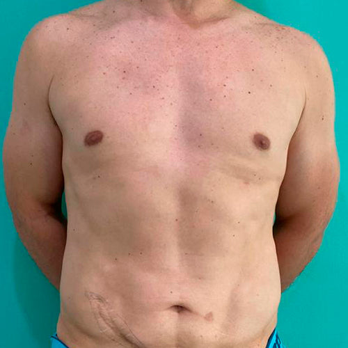 Lipoescultura localizada