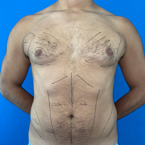 Lipoescultura localizada