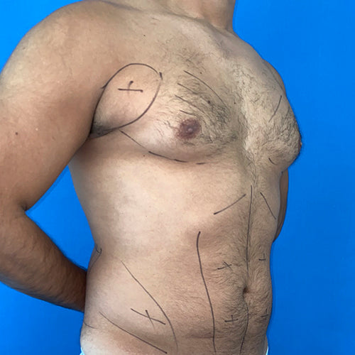 Lipoescultura localizada