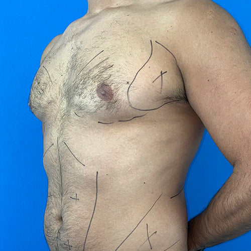 Lipoescultura localizada