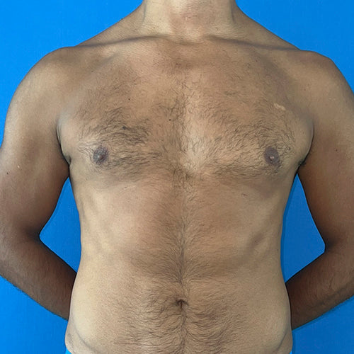 Lipoescultura localizada