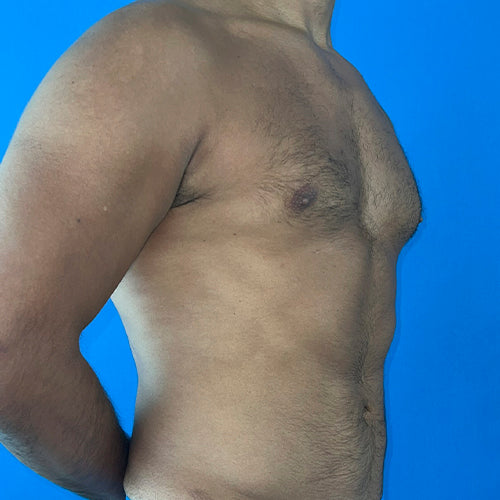 Lipoescultura localizada