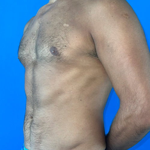 Lipoescultura localizada