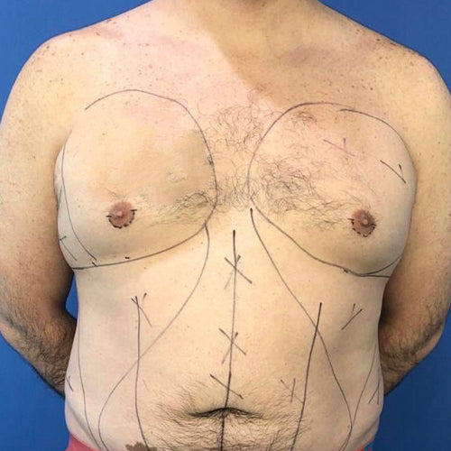 Lipoescultura localizada