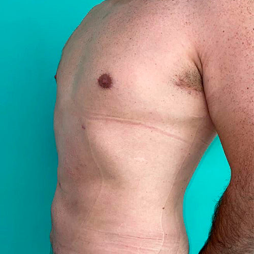 Lipoescultura localizada