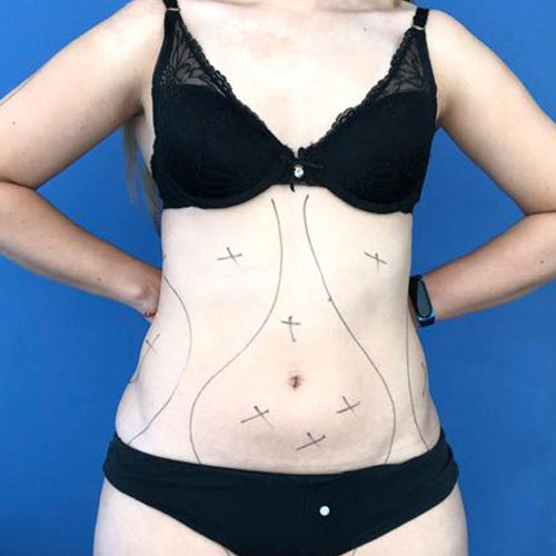 Lipoescultura localizada