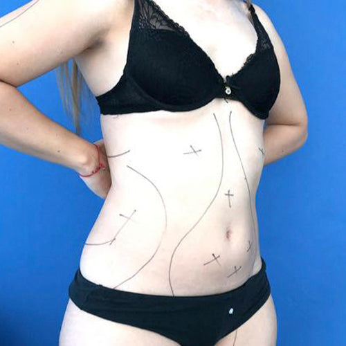 Lipoescultura localizada