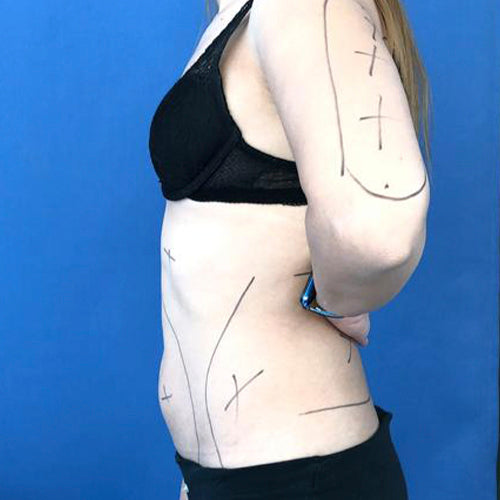 Lipoescultura localizada