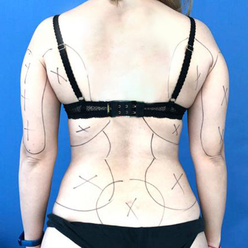 Lipoescultura localizada