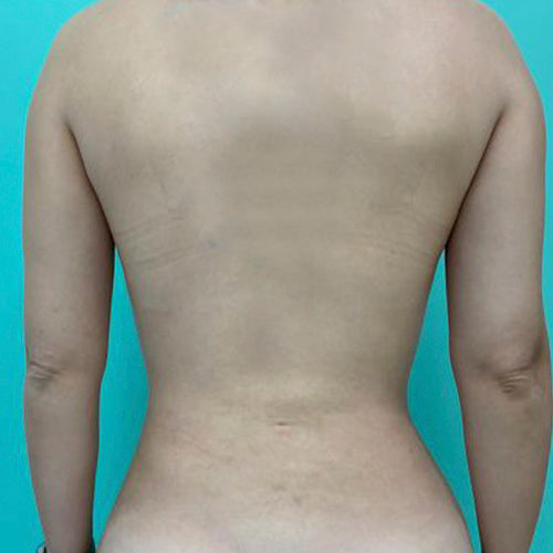 Lipoescultura localizada