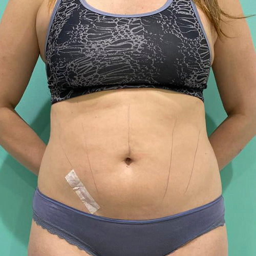 Lipoescultura localizada