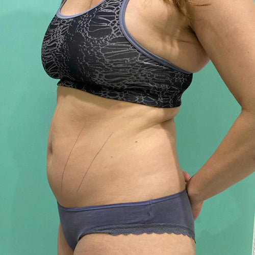 Lipoescultura localizada