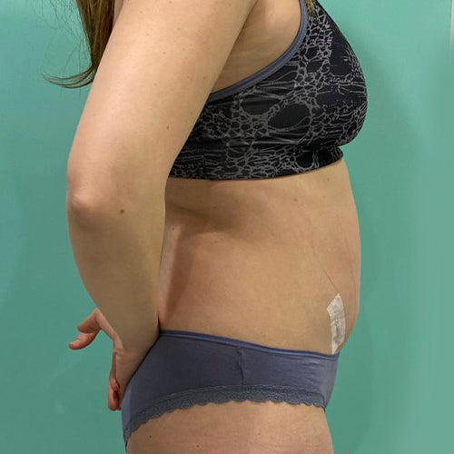 Lipoescultura localizada