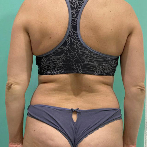 Lipoescultura localizada