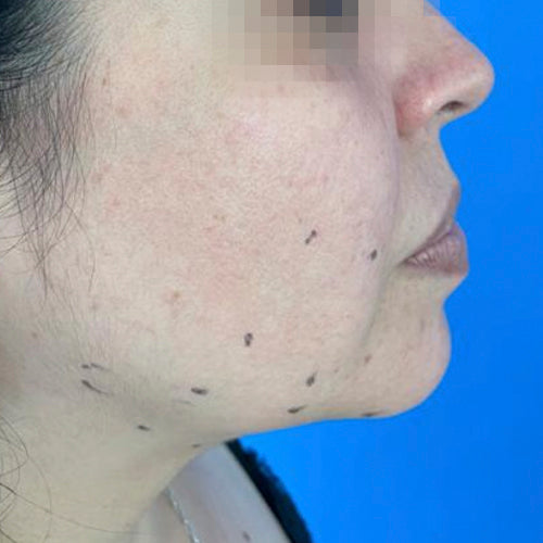 Liposucción de papada