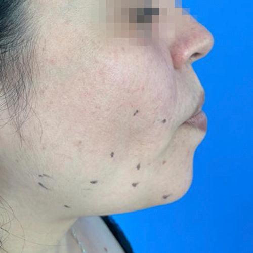 Liposucción de papada