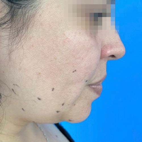 Liposucción de papada