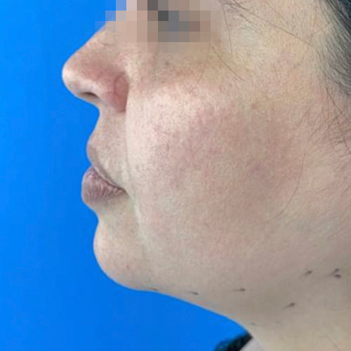 Liposucción de papada