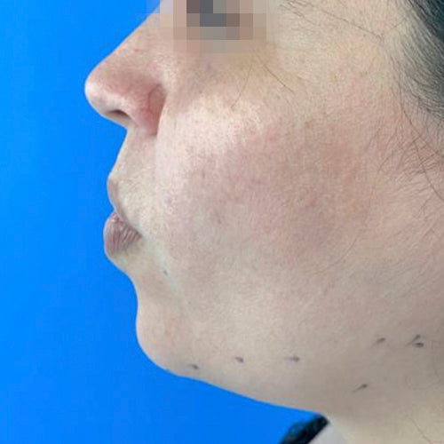 Liposucción de papada