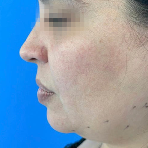 Liposucción de papada