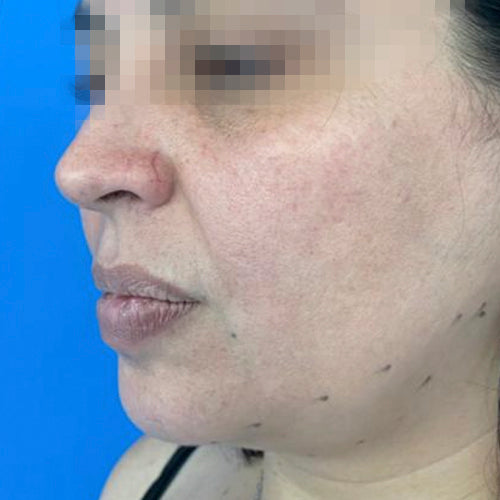 Liposucción de papada