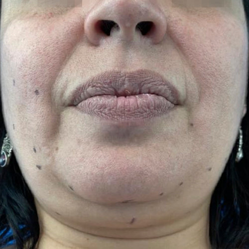 Liposucción de papada