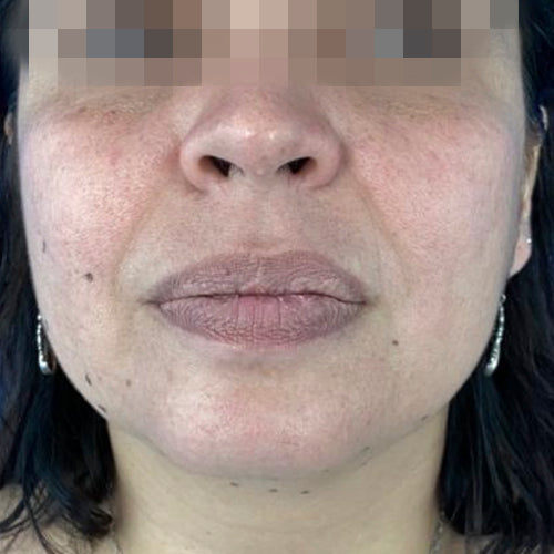 Liposucción de papada