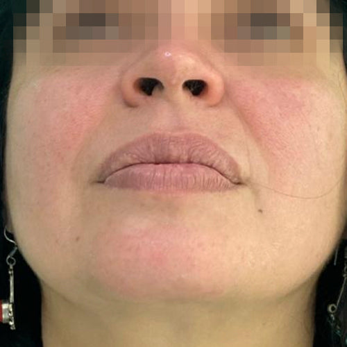 Liposucción de papada