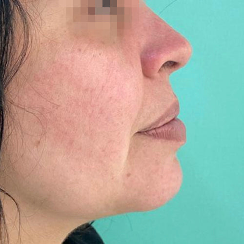 Liposucción de papada