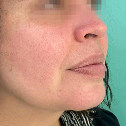 Liposucción de papada