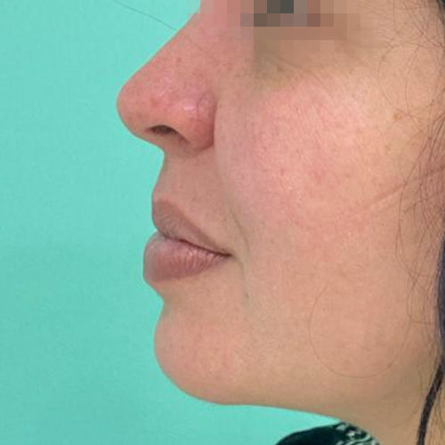 Liposucción de papada