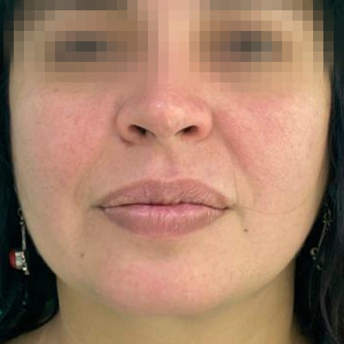 Liposucción de papada