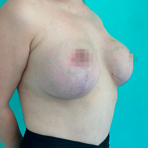 Mastopexia