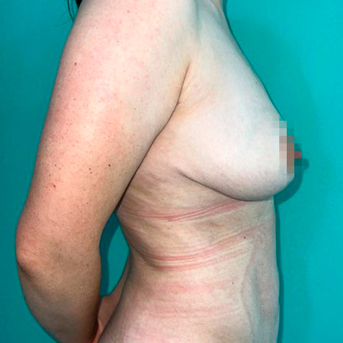 Reducción mamaria
