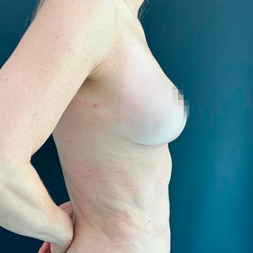 Reducción mamaria