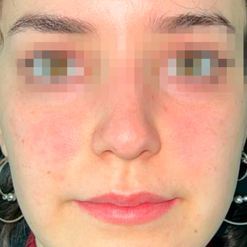 Rinoplastía &lt;h6&gt;(cirugía de nariz)&lt;/h6&gt;