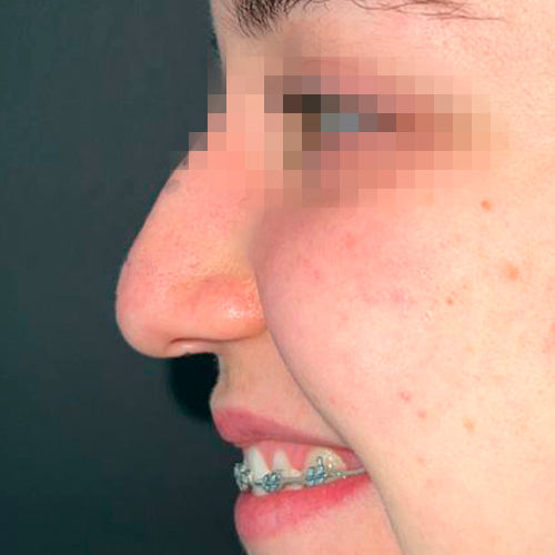 Rinoplastía &lt;h6&gt;(cirugía de nariz)&lt;/h6&gt;