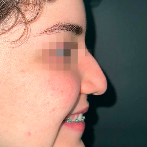 Rinoplastía &lt;h6&gt;(cirugía de nariz)&lt;/h6&gt;