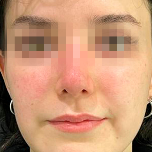 Rinoplastía &lt;h6&gt;(cirugía de nariz)&lt;/h6&gt;