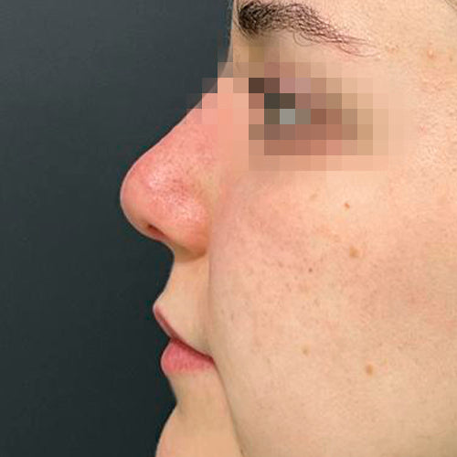 Rinoplastía &lt;h6&gt;(cirugía de nariz)&lt;/h6&gt;